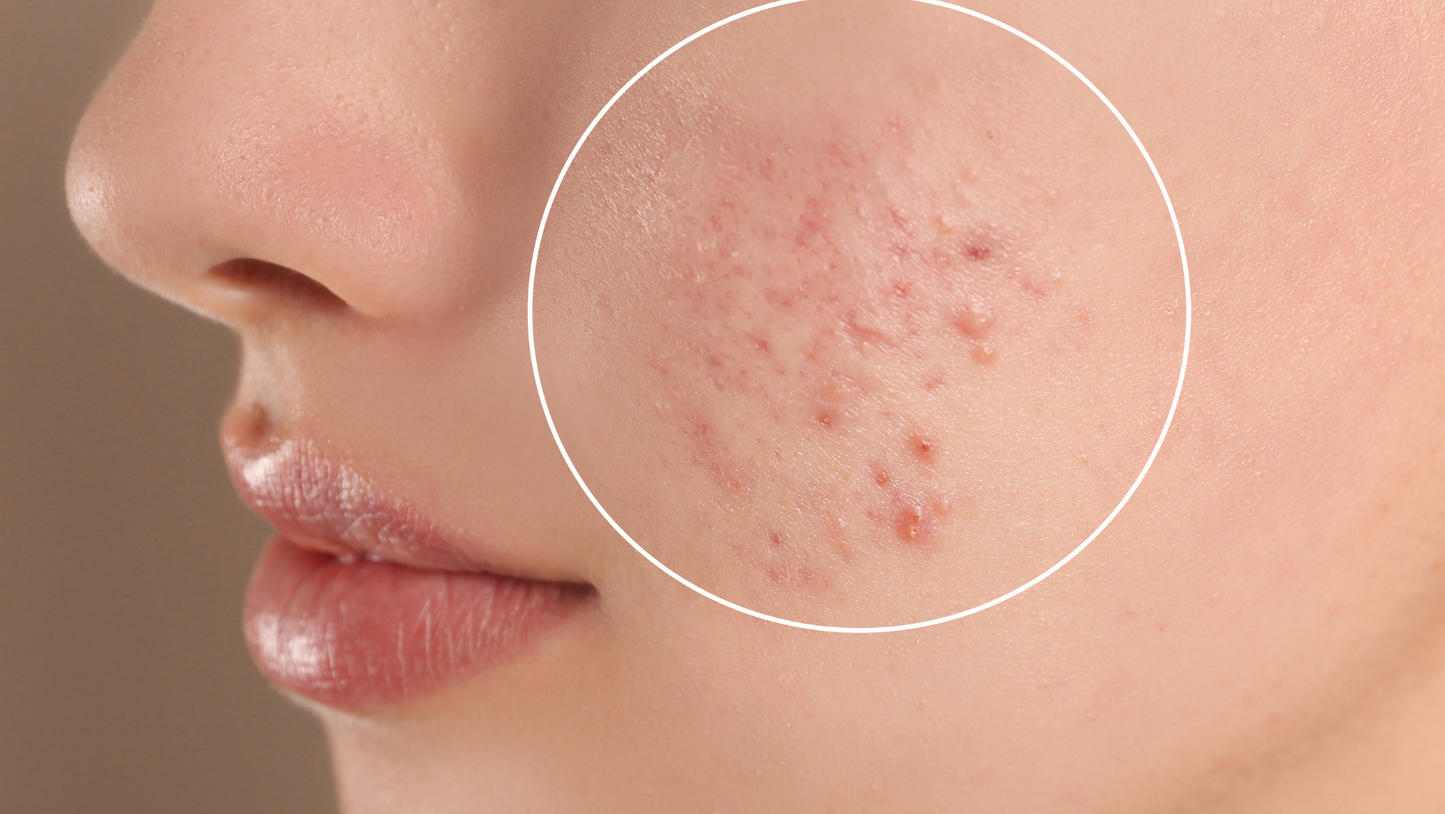 Tratamientos Faciales