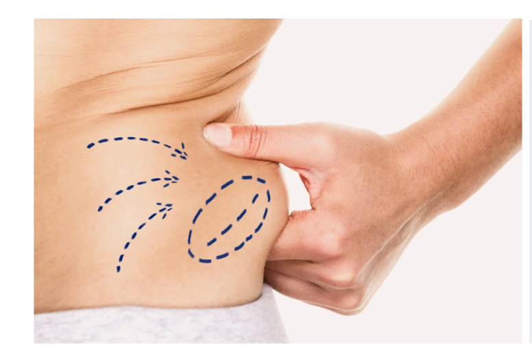 Localized Fat Reduction Injections