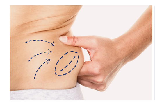 Inyecciones de Reducción de Grasa Localizada